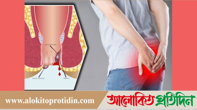 পাইলস কেন হয়, লক্ষণগুলো কী!